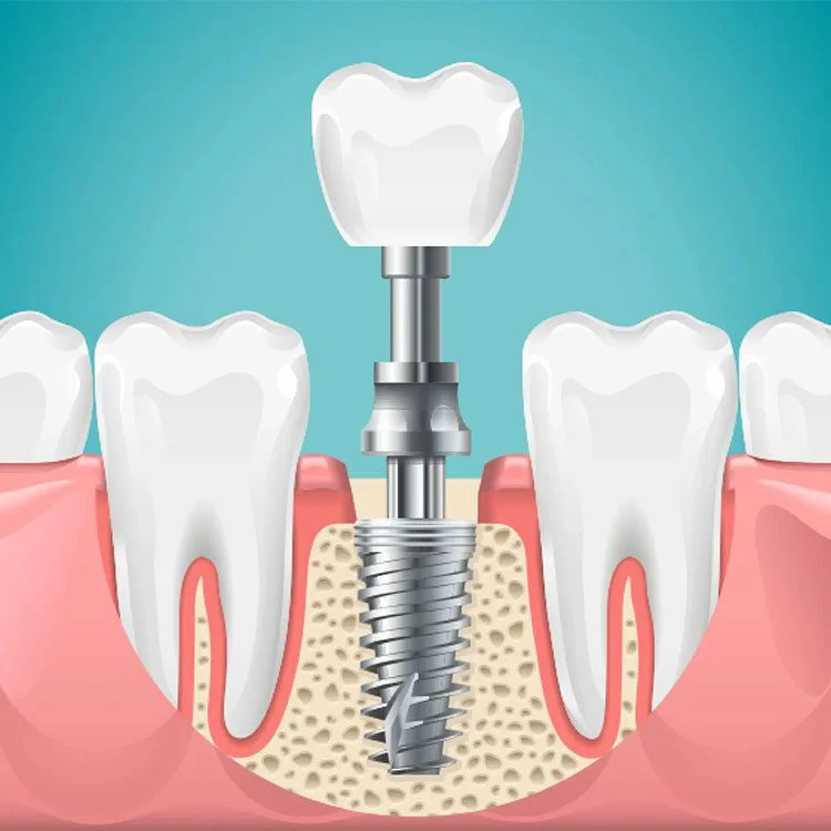 Dental Implants at Keluarga Dental Smile, Sentul Kuala Lumpur